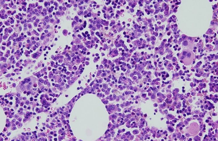 Mejorar la calidad de vida de pacientes con Mieloma Múltiple sí es posible Mieloma Multiple - Formula Medica