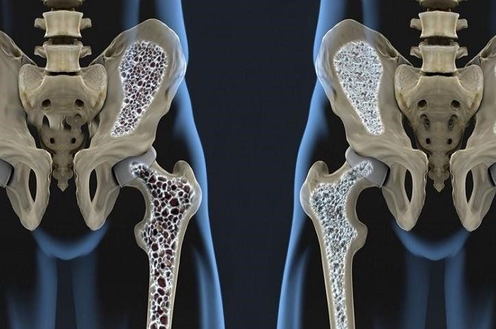 Osteoporosis: Una amenaza silenciosa que afecta sus huesos Osteoporosis - Formula Medica