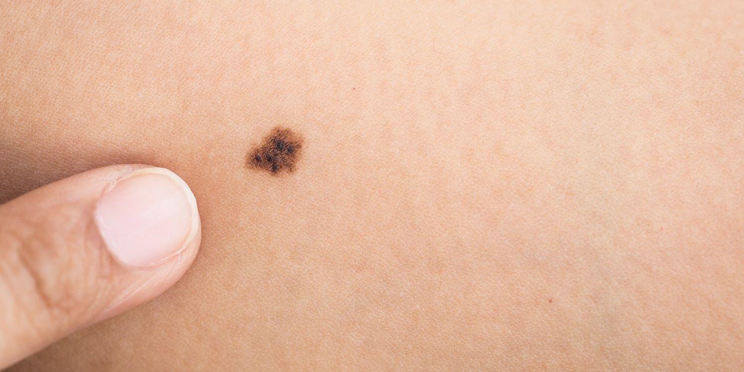 Invima aprueba novedoso tratamiento para el melanoma Melanoma - Formula Medica
