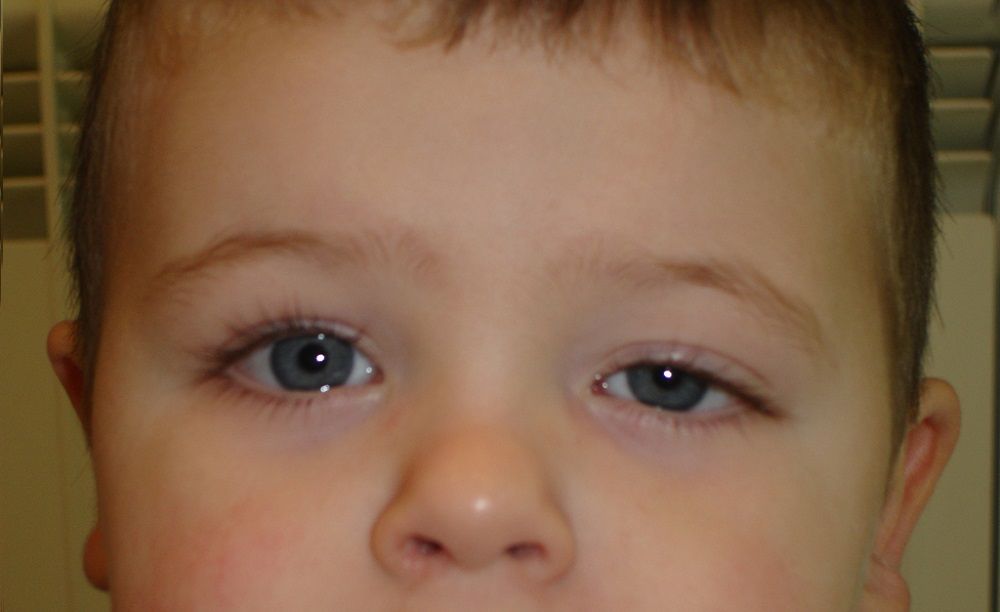Ptosis Palpebral - Formula Medica Ptosis Palpebral - Formula Medica