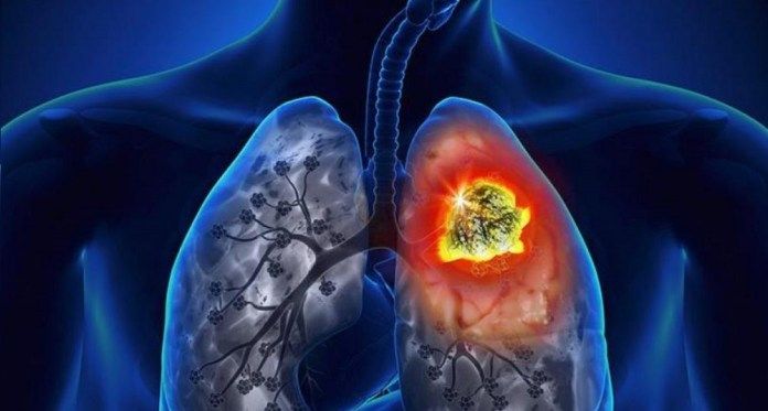Cancer de pulmon - Formula Medica