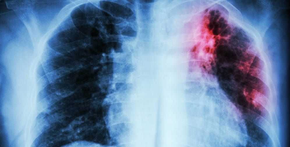¿Por qué esperar? La Fibrosis Pulmonar Idiopática no espera Fibrosis Pulmonar Idiopatica - Formula Medica