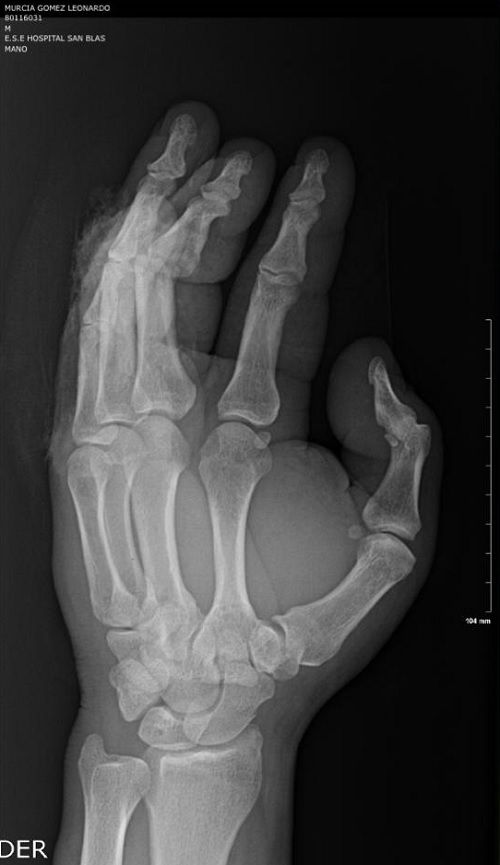 Lesion en la mano - Formula Medica