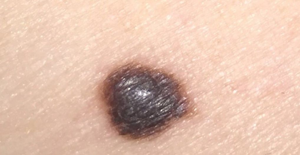 Guía para reconocer uno de los peores tipos de cáncer de piel Melanoma - Formula Medica