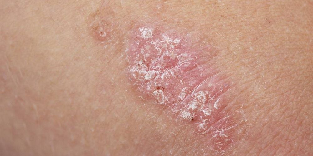 Los pacientes de psoriasis tienen hoy una nueva oportunidad para tratar su enfermedad Psoriasis - Formula Medica