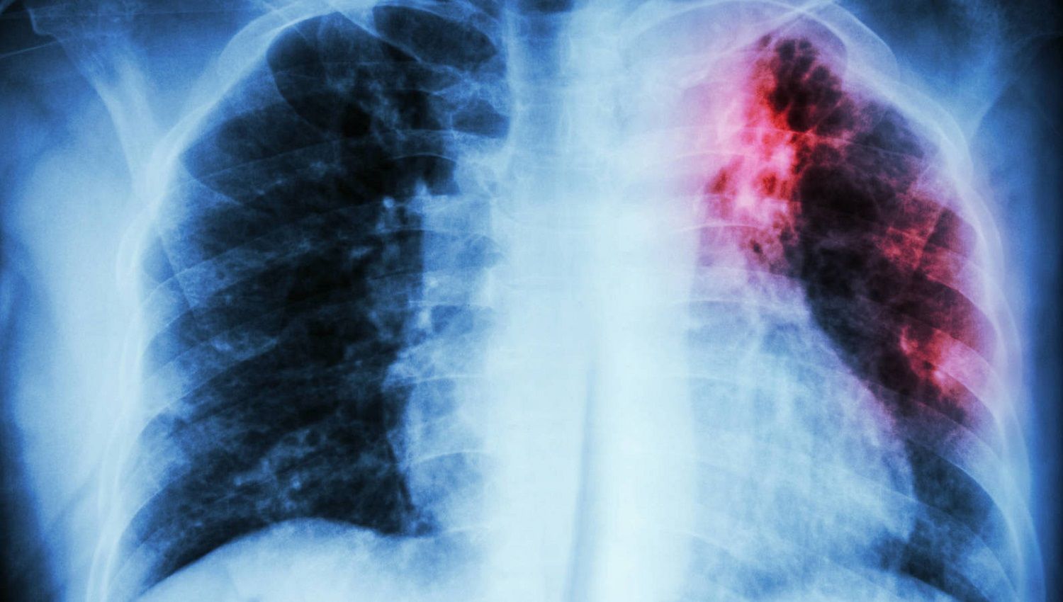 Fibrosis Pulmonar Idiopática - Fórmula Médica
