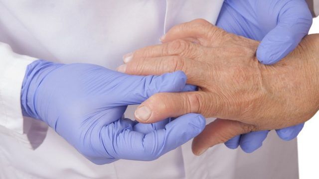 Artritis Reumatoidea durante el COVID-19 - Fórmula Médica