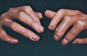 La detección temprana de esclerodermia, clave para prevenir afectaciones pulmonares Esclerodermia - Fórmula Médica
