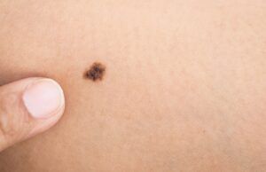 En tiempos de cuarentena, el cáncer de piel no se detiene Cáncer de piel - Fórmula Médica