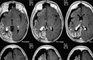 Derivado de los componentes del cannabis puede ser útil para el tratamiento de la epilepsia refractaria Epilepsia Refractaria - Fórmula Médica