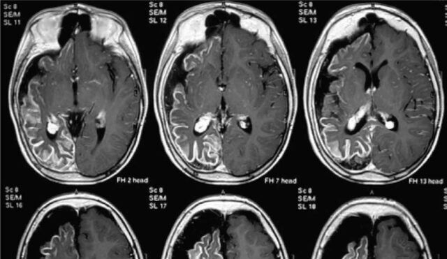 Epilepsia Refractaria - Fórmula Médica Epilepsia Refractaria - Fórmula Médica