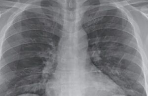 La severidad del COVID-19 depende de la cantidad de virus Pulmones atacados por el COVID-19 - Fórmula Médica