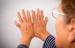 Ojo con la Artritis Reumatoidea Artritis reumatoidea - Fórmula Médica