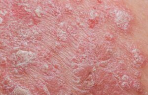 Psoriasis en época de pandemia Psoriasis - Fórmula Médica