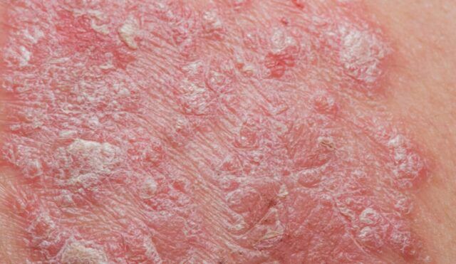 Psoriasis - Fórmula Médica