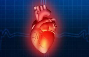 La fibrilación auricular aumenta el riesgo de sufrir un ataque cerebrovascular Fibrilación auricular - Fórmula Médica