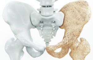 Cinco tips para prevenir la osteoporosis Osteoporosis - Fórmula Médica