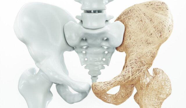 Osteoporosis - Fórmula Médica