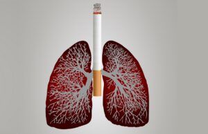 !Cáncer de pulmón¡ Que un diagnóstico tardío no le quite el aire Cáncer de pulmón - Fórmula Médica