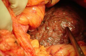 ¿Qué son y cómo identificar los tumores neuroendocrinos? Tumores digestivos - Fórmula Médica