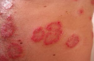 Dermatitis Atópica genera riesgo emocional y psicosocial en niños y adolescentes Dermatitis Atópica - Fórmula Médica