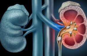 De la salud del riñón depende el equilibrio de todo el organismo Riñones - Fórmula Médica