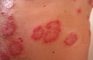 Rastros de la Dermatitis Atópica: más allá de la piel Dermatitis Atópica - Fórmula Médica