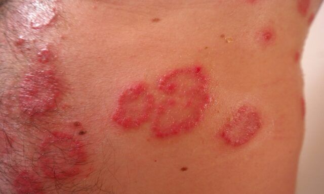 Dermatitis Atópica - Fórmula Médica Dermatitis Atópica - Fórmula Médica