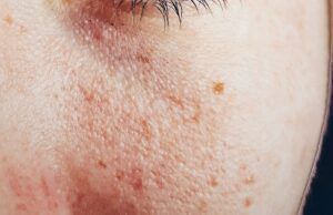 Estudio revela que la pandemia del COVID-19 aumentó los brotes de la dermatitis atópica entre los colombianos Dermatitis Atópica - Fórmula Médica