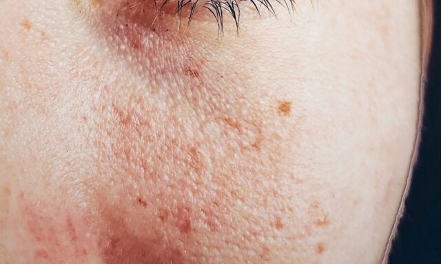 Dermatitis Atópica - Fórmula Médica Dermatitis Atópica - Fórmula Médica