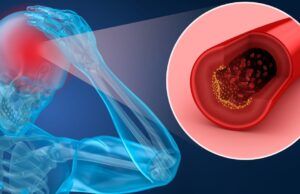 Identificar las señales de un accidente cerebrovascular es clave para sobrevivir sin secuelas Accidente cerebrovascular - Fórmula Médica