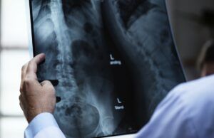 Menos del 20% de los pacientes con osteoporosis reciben un tratamiento adecuado Osteoporosis - Fórmula Médica