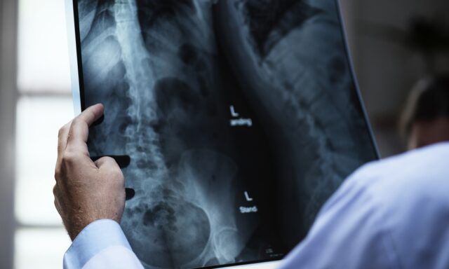 Osteoporosis - Fórmula Médica Osteoporosis - Fórmula Médica