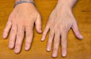 Acromegalia: un trastorno que no debería pasar desapercibido Acromegalia - Fórmula Médica