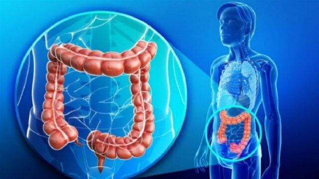 Cáncer de colon - Fórmula Médica Cáncer de colon - Fórmula Médica