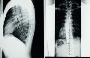 El cáncer de pulmón es la primera causa de muerte por cáncer a nivel mundial Cáncer de pulmón - Fórmula Médica