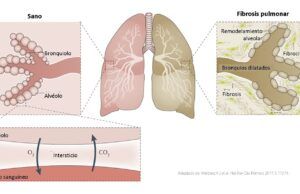 Primer y único tratamiento para enfermedades intersticiales del pulmón en Colombia Enfermedades Pulmonares Intersticiales con Fenotipo Fibrosante Progresivo - Fórmula Médica