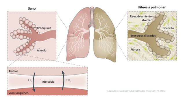 Enfermedades Pulmonares Intersticiales con Fenotipo Fibrosante Progresivo - Fórmula Médica Enfermedades Pulmonares Intersticiales con Fenotipo Fibrosante Progresivo - Fórmula Médica
