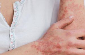 9 de cada 10 pacientes con lupus son mujeres Lupus - Fórmula Médica