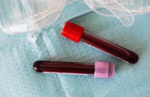 Qué es la Púrpura Trombocitopénica Trombótica Sangre - Fórmula Médica
