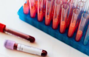 Púrpura Trombocitopénica Trombótica: por cada hombre, dos mujeres padecen la enfermedad Púrpura Trombocitopénica Trombótica - Fórmula Médica