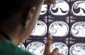 Accidente cerebrovascular: atención en las primeras cuatro horas aumenta la posibilidad de sobrevida Accidente cerebrovascular - Fórmula Médica