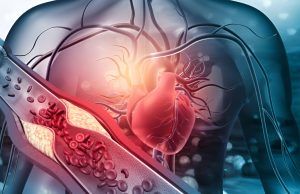 El 25 % de las muertes en el mundo son causadas por la trombosis Trombosis - Fórmula Médica