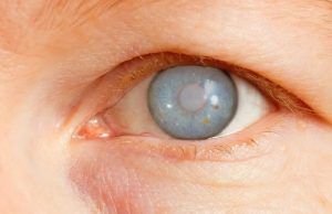 El glaucoma, una enfermedad silenciosa que alerta a los colombianos Glaucoma - Fórmula Médica