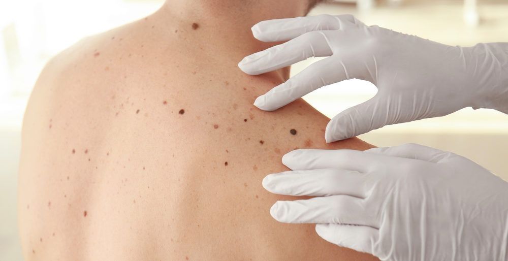 Melanoma Cutáneo Maligno - Fórmula Médica