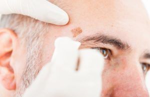 Cómo prevenir y detectar a tiempo el Melanoma Cutáneo Maligno Melanoma Cutáneo Maligno - Fórmula Médica
