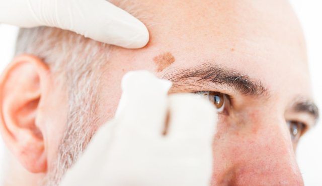 Melanoma Cutáneo Maligno - Fórmula Médica Melanoma Cutáneo Maligno - Fórmula Médica