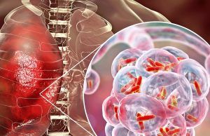 Tuberculosis: Una enfermedad que persiste Tuberculosis - Fórmula Médica