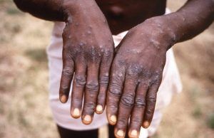 Colombia Refuerza Vigilancia ante declaratoria de Emergencia Internacional por Mpox clado I o Viruela del Mono Mpox clado I - Fórmula Médica
