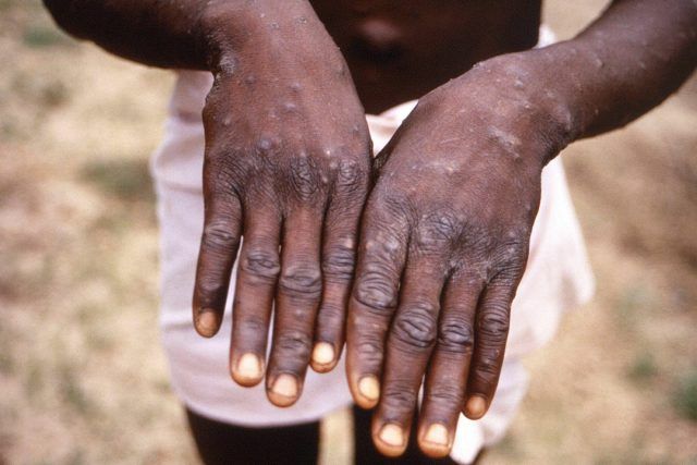 Mpox clado I - Fórmula Médica Mpox clado I - Fórmula Médica